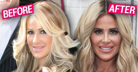 //Kim Zolciak Biermann Plastic Surgery Exposed RHOA pp