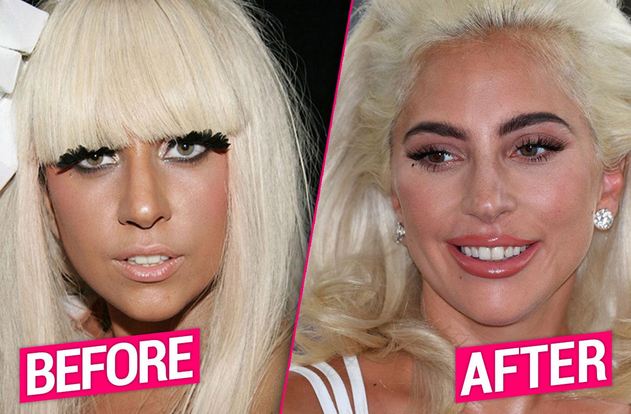 Lady Gagas Plastic Surgery Makeover Exposed By Top Docs 3741