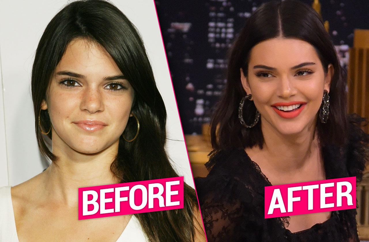 Kendall Jenner's Plastic Surgery Exposed By Top Docs