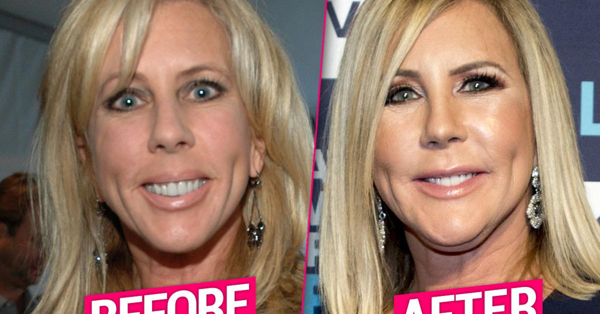 ‘RHOC’ Star Vicki Gunvalson Flaunts New Face After Plastic Surgery Makeover