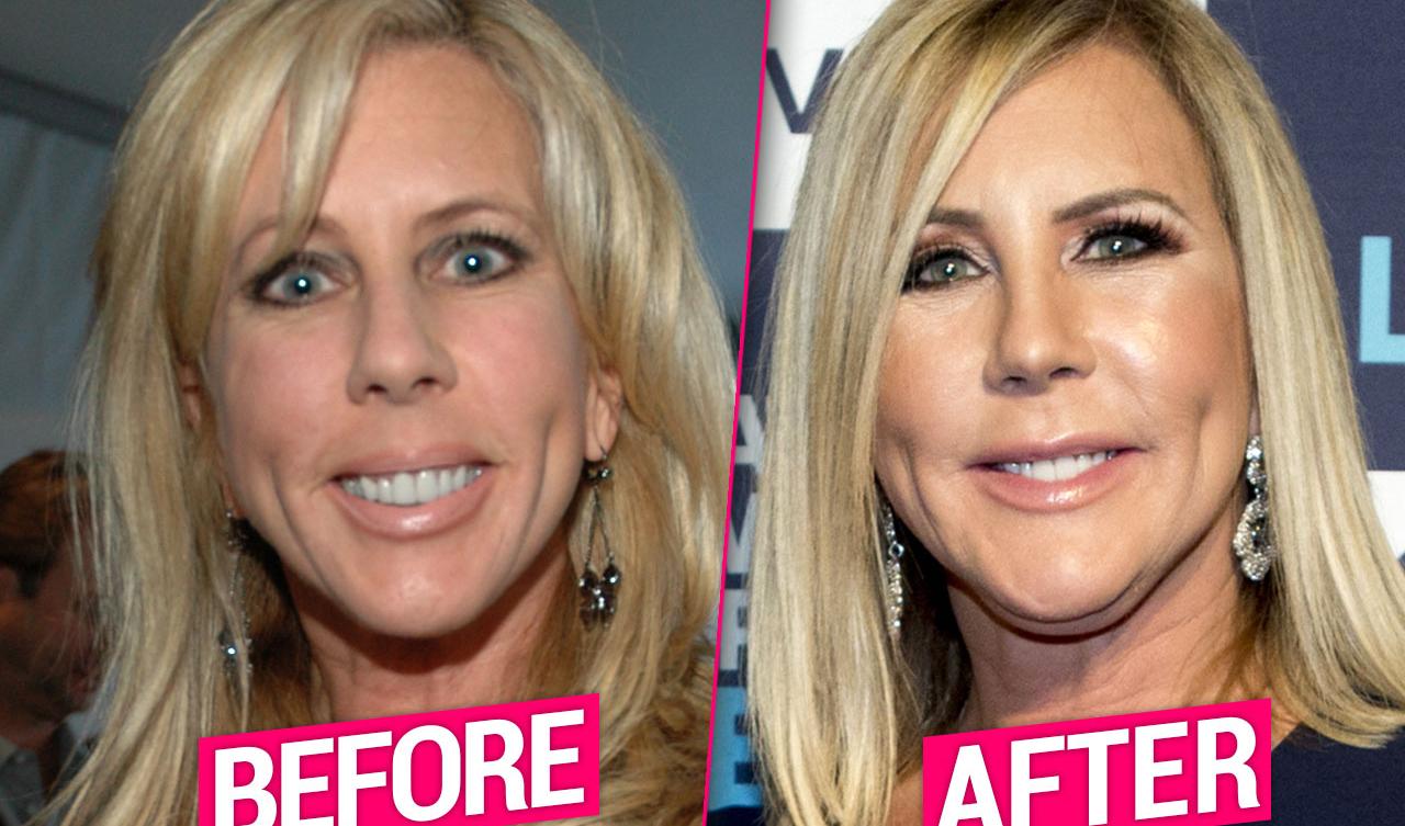 ‘RHOC’ Star Vicki Gunvalson Flaunts New Face After Plastic Surgery Makeover