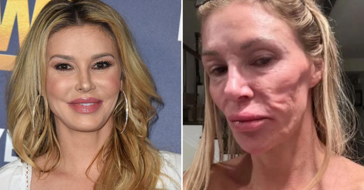 EXCLUSIVE: Inside Brandi Glanville's Exploding Boob Terror — How a 'Facial Parasite' and Ruptured 20-Year-Old Implant Have Left the Medical Community Baffled