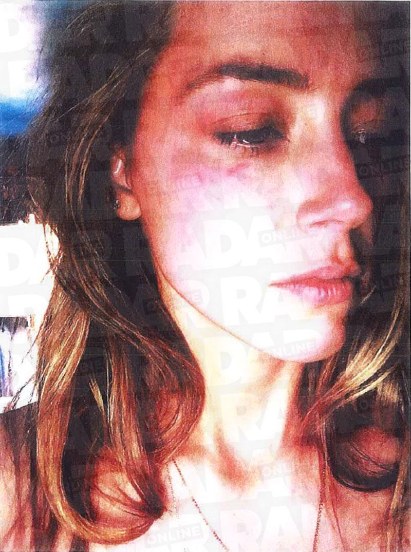 Amber Heard Johnny Depp Abuse Claims Photo Damage