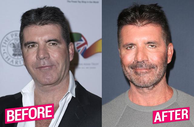 Simon Cowell Plastic Surgery Makeover Exposed By Top Docs