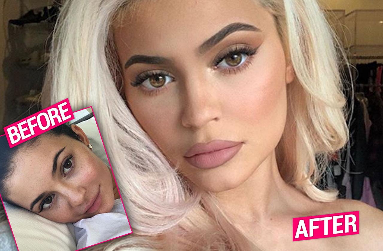 Kylie Jenner Gets Lip Fillers Back