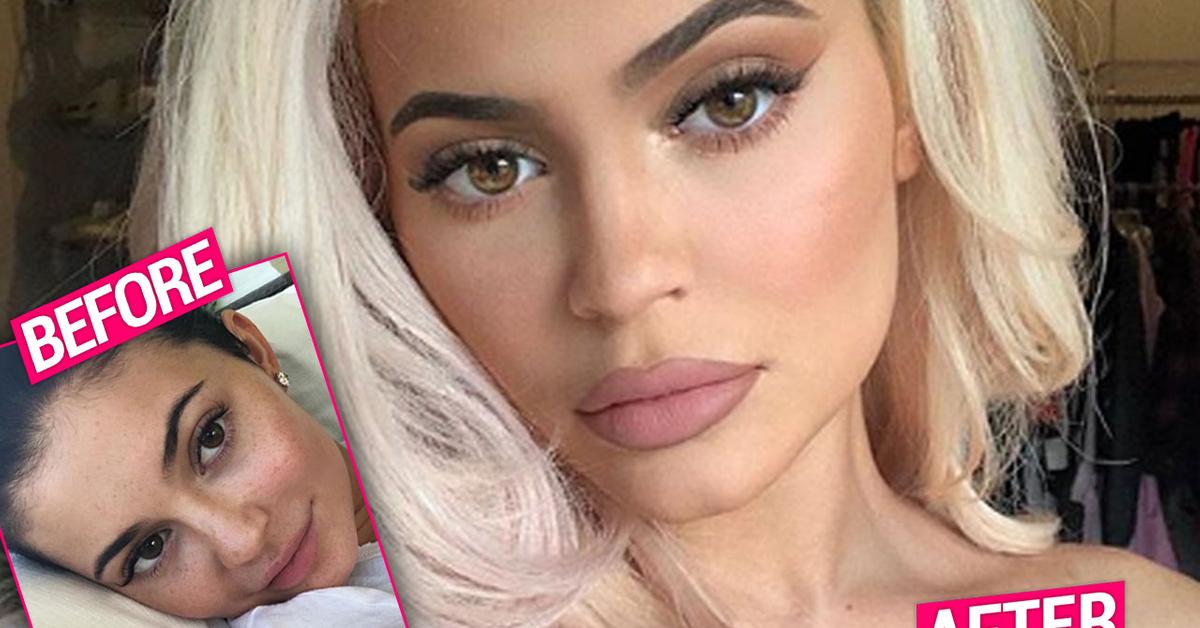 Kylie Jenner Gets Lip Fillers Back After Temporary Break 5405