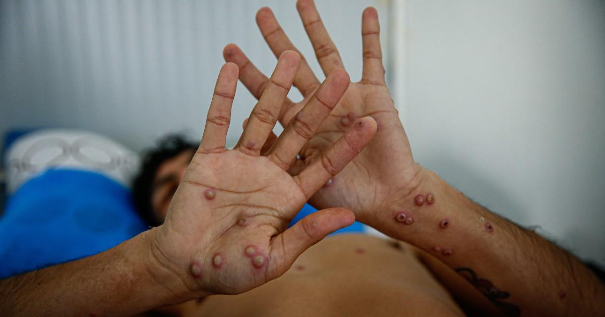 biden harris administration admit closely monitoring mpox infections