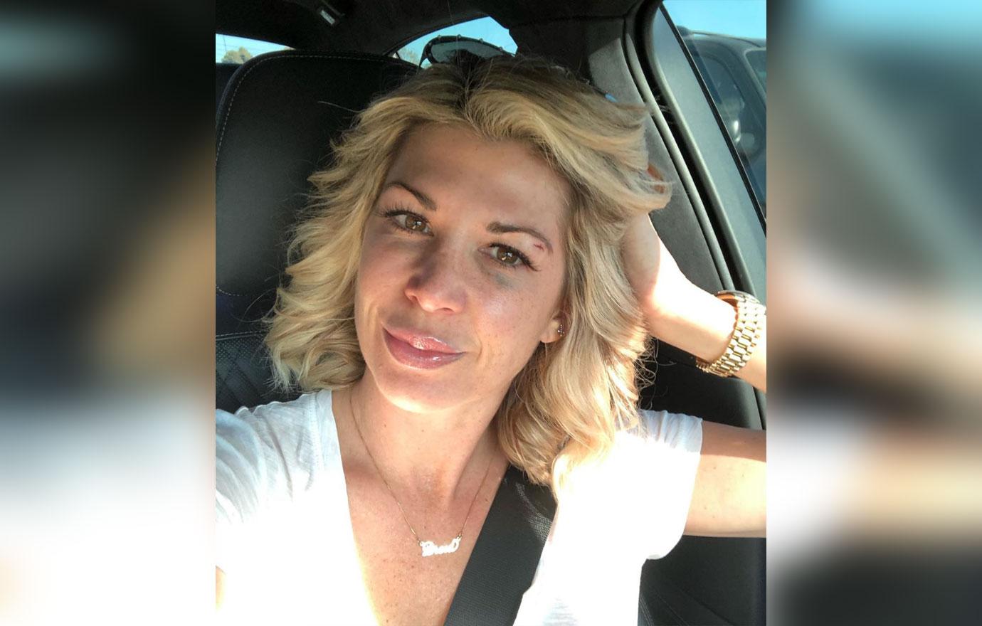 Alexis Bellino, Shocking Photos Of ‘RHOC’ Star Alexis Bellino Getting Plastic Surgery After Brutal Black Eye