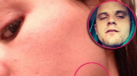 //jenelle bruise twitter