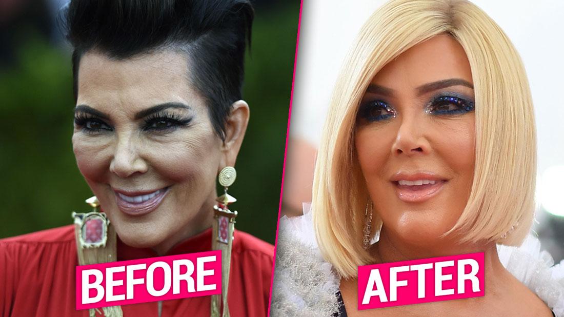 Kris Jenner S Plastic Surgery Makeover