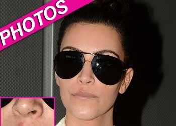 //pp_kimk_skinblemish