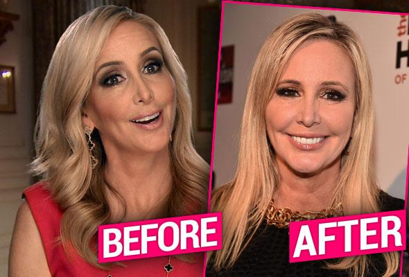 Shannon Beador's $2,500 Pre-Reunion CO2 Laser Facial: Details