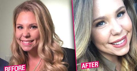 kailyn lowry plastic surgery lip injections