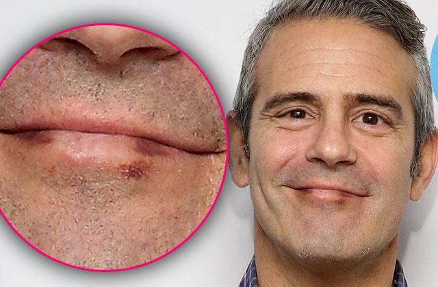 Andy Cohen Cancer Diagnosis Skin Lip Mark Pics