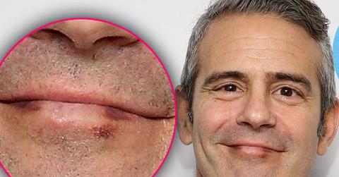 Andy Cohen Cancer Diagnosis Skin Lip Mark Pics