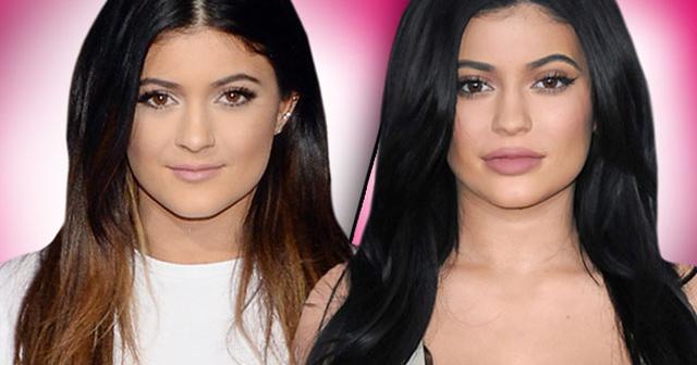 Fill 'er Up! Kylie Jenner’s New Face Came From A Needle, Docs Claim