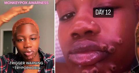 georgia woman positive monkeypox shares story tiktok fights misinformationjpg