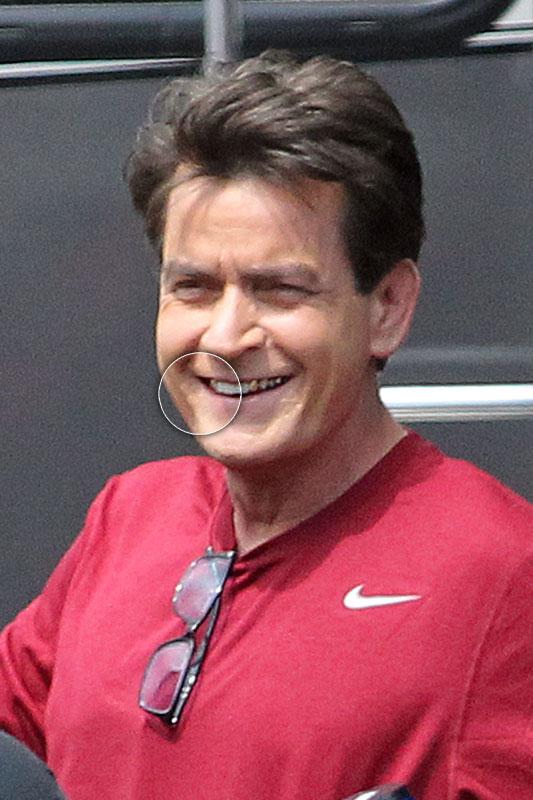 Charlie Sheen HIV Positive Lesions Face