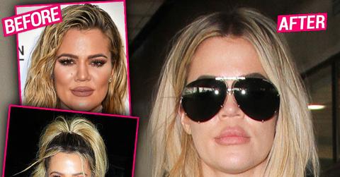 khloe kardashian plastic surgery lips face