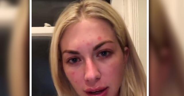 Stassi Schroeder Reveals Psoriasis Makeup Free Photo