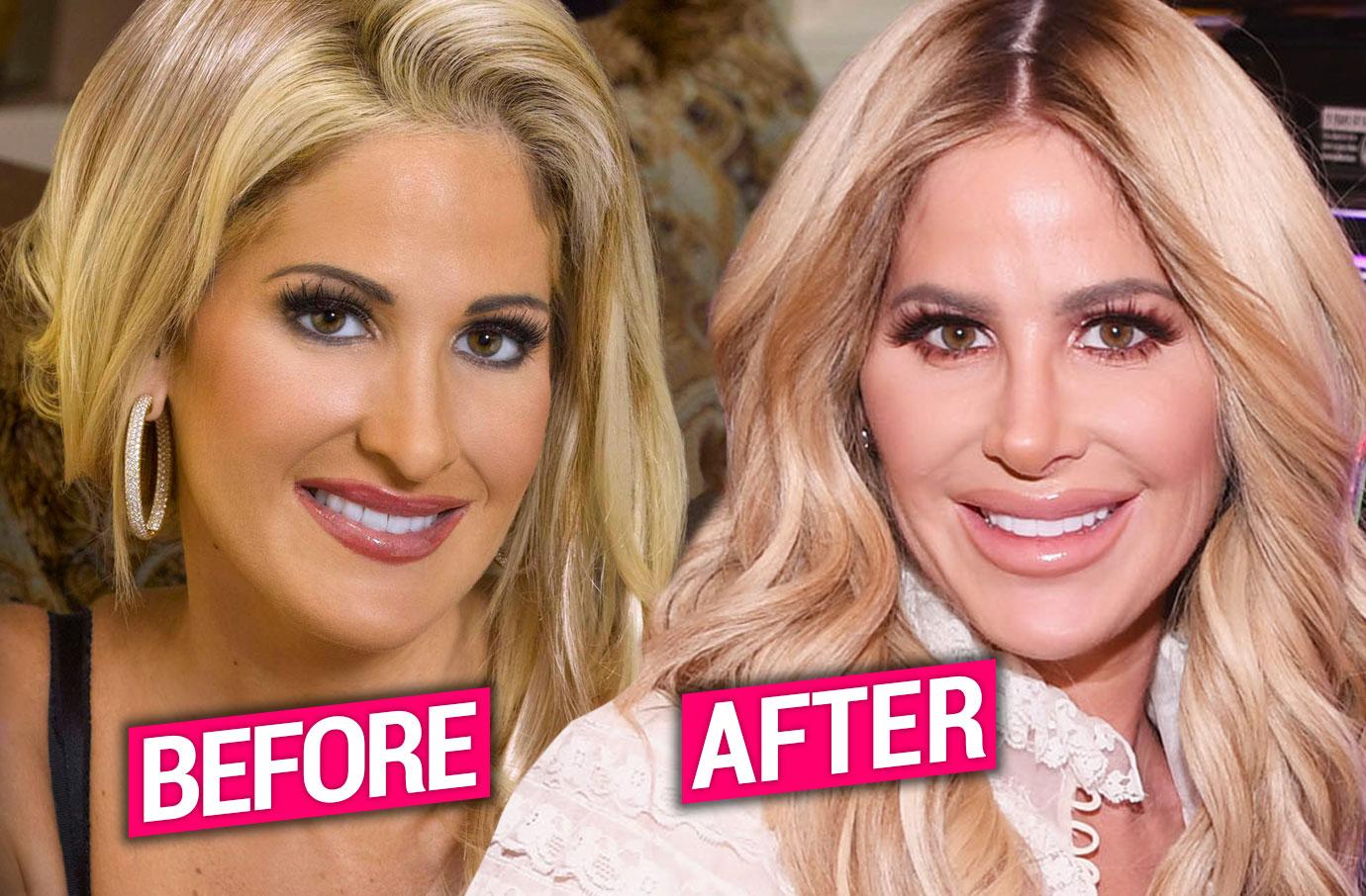 kim zolciak before and after tummy tuck