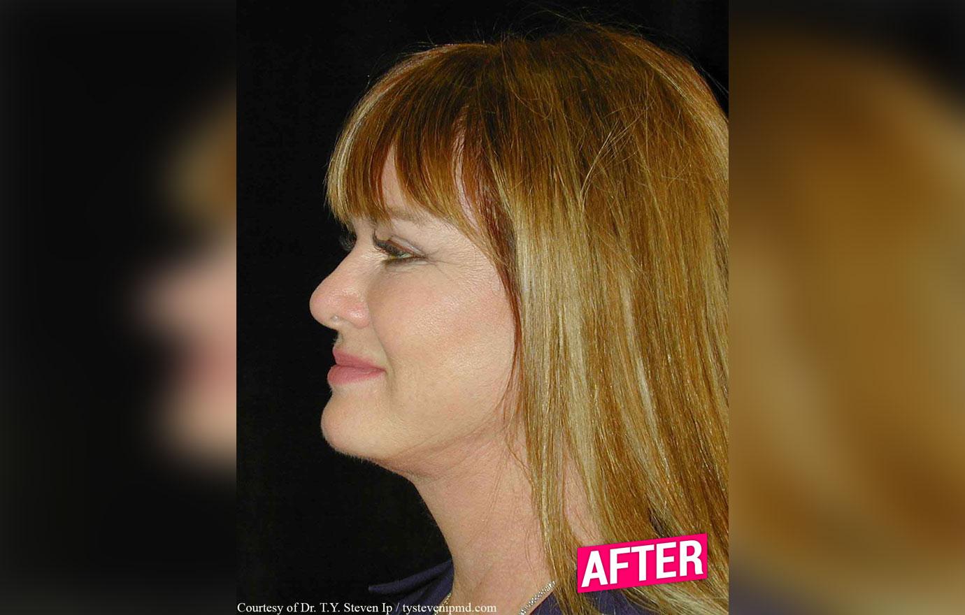 //rhoc Jeana Keough plastic surgery makeover