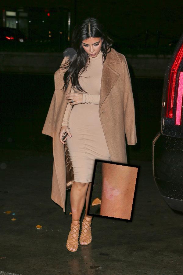 //kim kardashian psoriasis