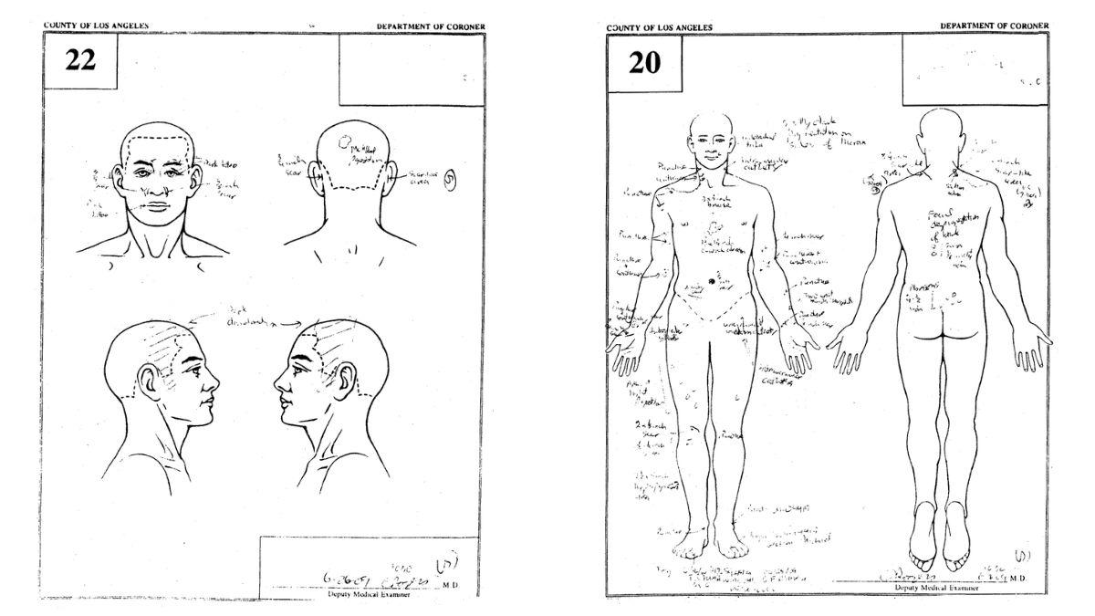 Photo of Michael Jackson autopsy