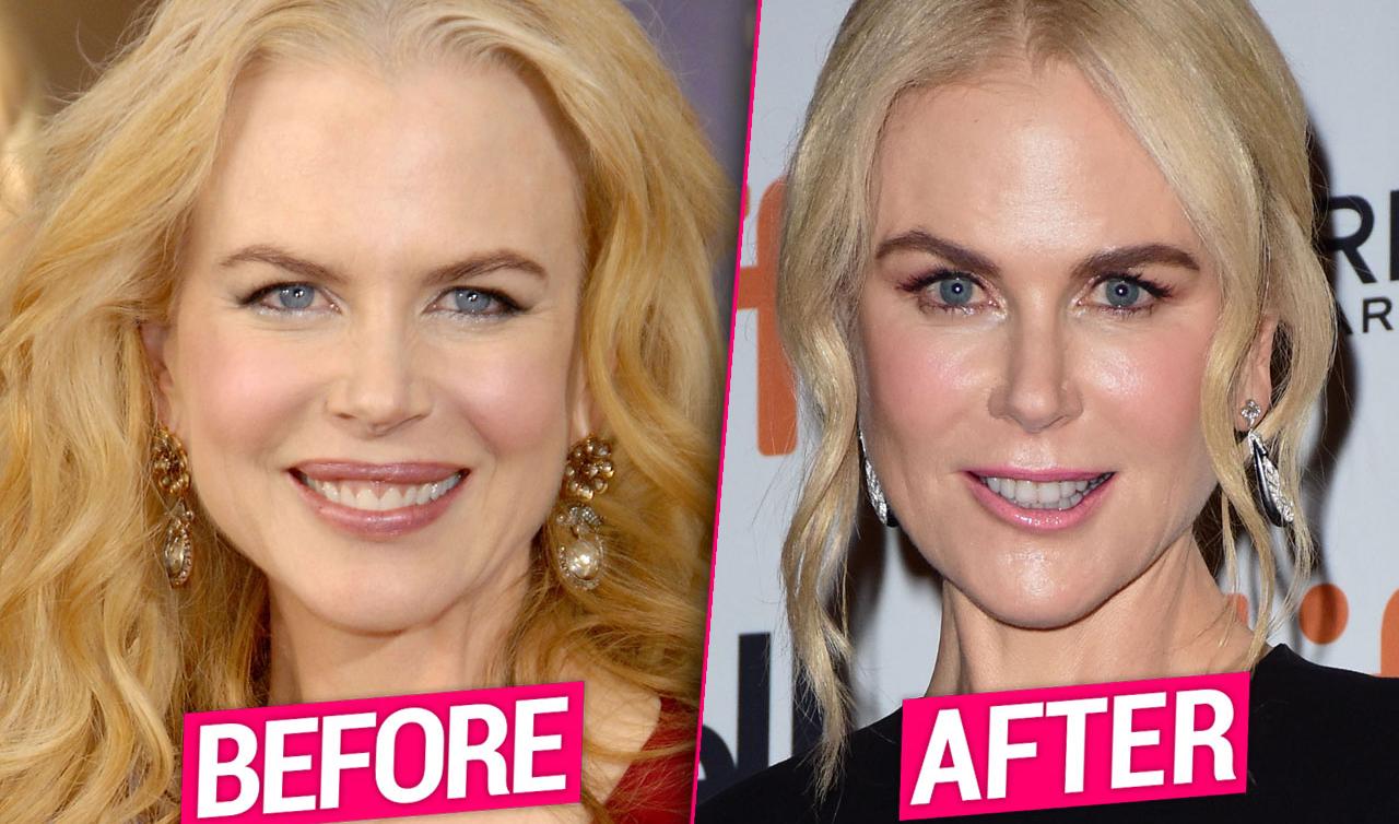 Nicole Kidman's Evolving Beauty Uncovering The Truth Behind The Nose