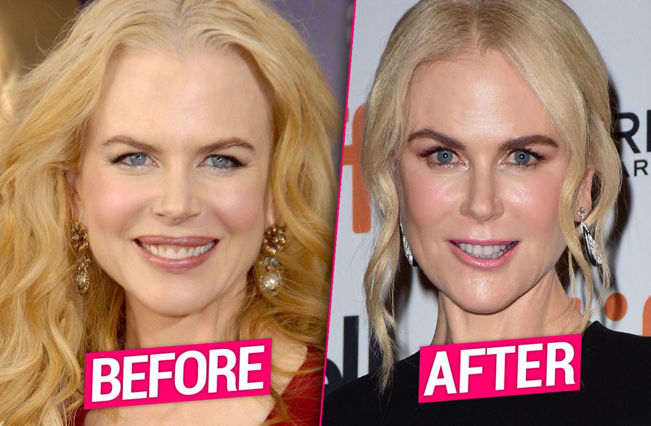 Nicole Kidman Plastic Surgery Facelift Fillers Botox Pp 