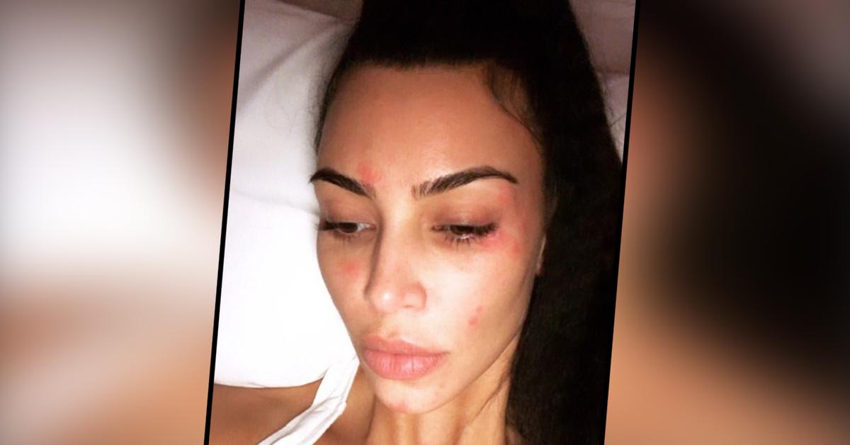 Kim Kardashian Shows Off Morning Psoriasis In Candid New Selfie