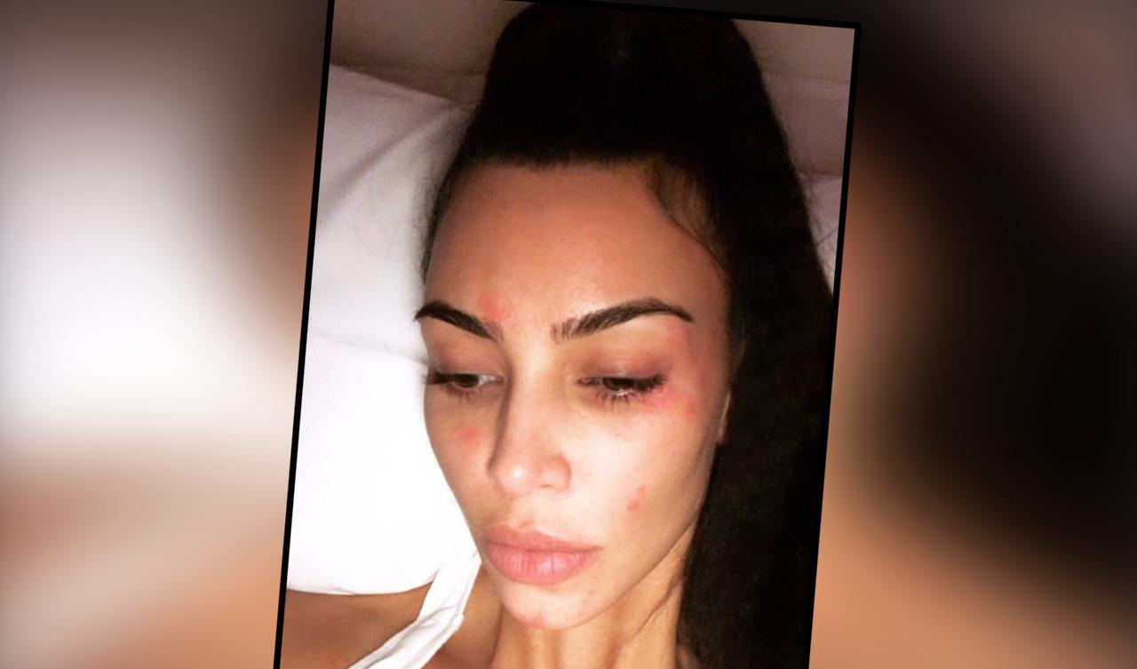 Kim Kardashian Shows Off Morning Psoriasis In Candid New Selfie