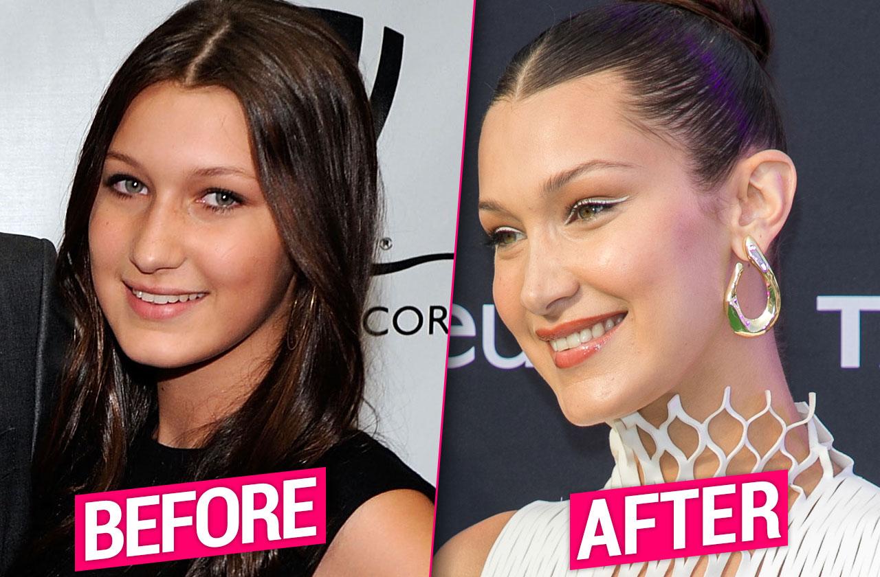 Bella Hadid Before Plastic Did Bella Hadid Get A Nose Job Page Six