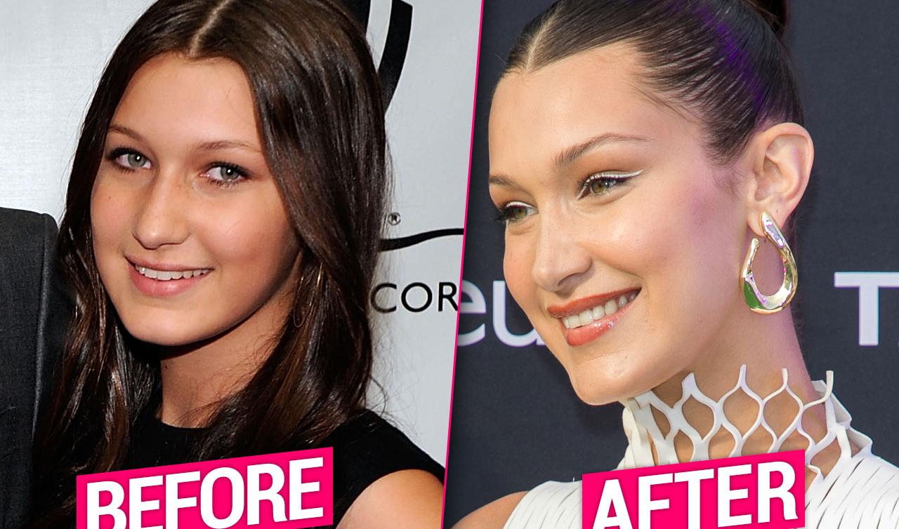 Bella Hadid – Supermodel’s Denial Of Plastic Surgery May Be A Lie