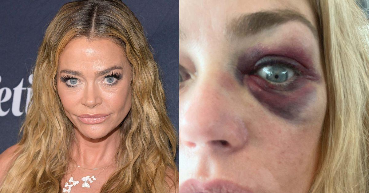 Richards has filmed scenes tied to a bruised eye, abuse claims and legal battles.