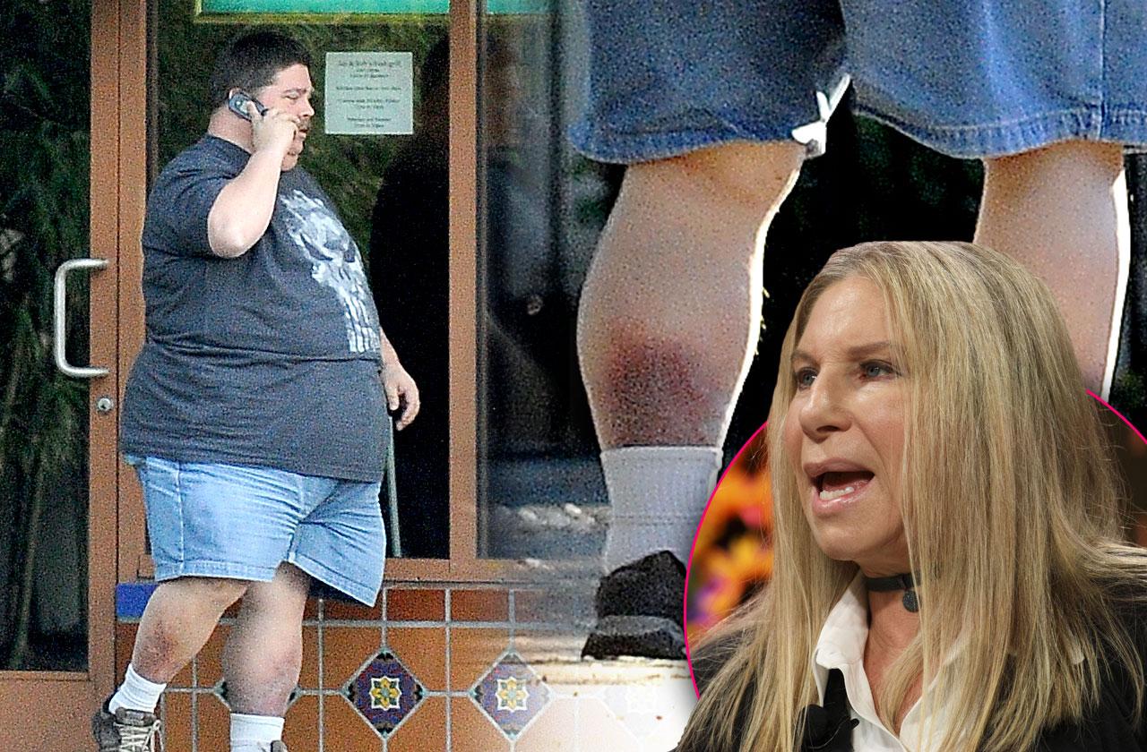 //barbara streisand stepson jess brolin obese amputation fears pp