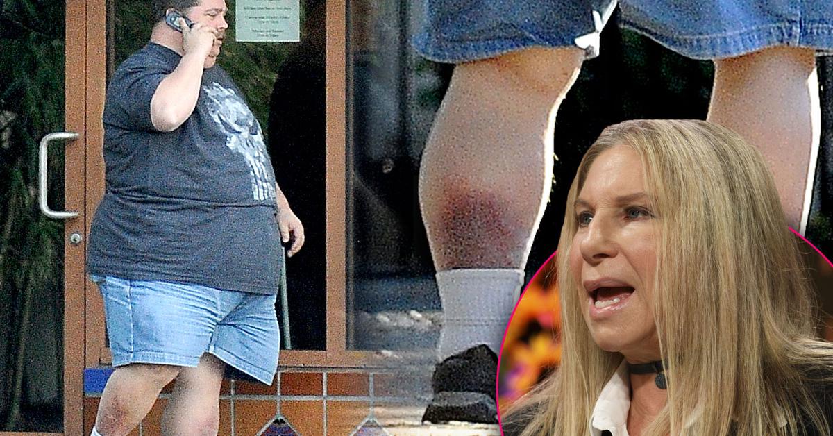 Barbra Streisand's Obese Stepson May Need To Amputate Legs