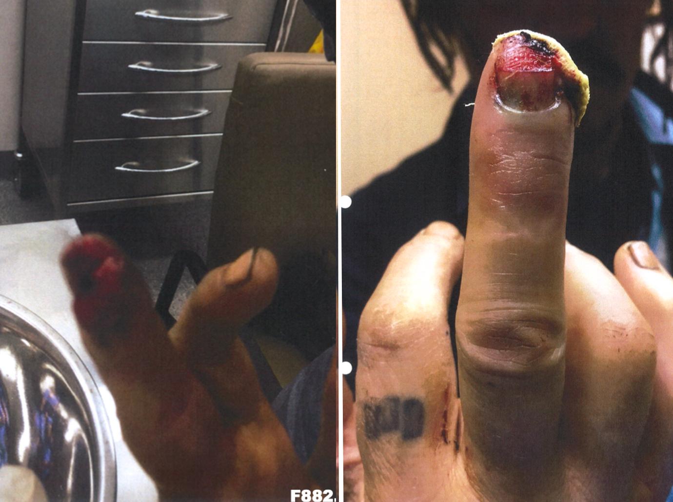 finger split pic