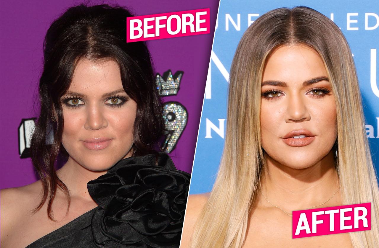 Khloe Kardashian Plastic Surgery: Before, After Photos