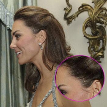 //kate middleton scar head_