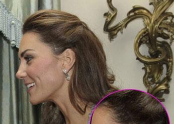 //kate middleton scar head_