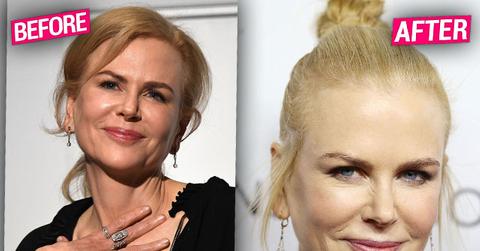 nicole kidman plastic surgeries