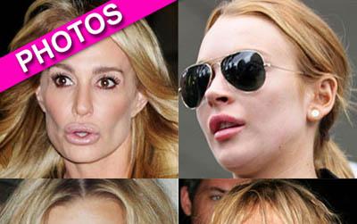 //plastic surgery lipsbfd