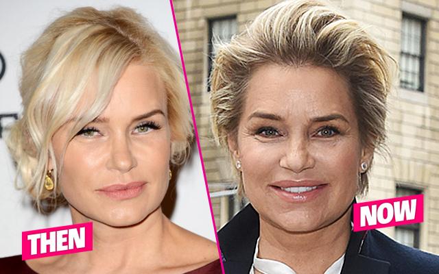 Yolanda Foster Plastic Surgery Botox Wrinkles