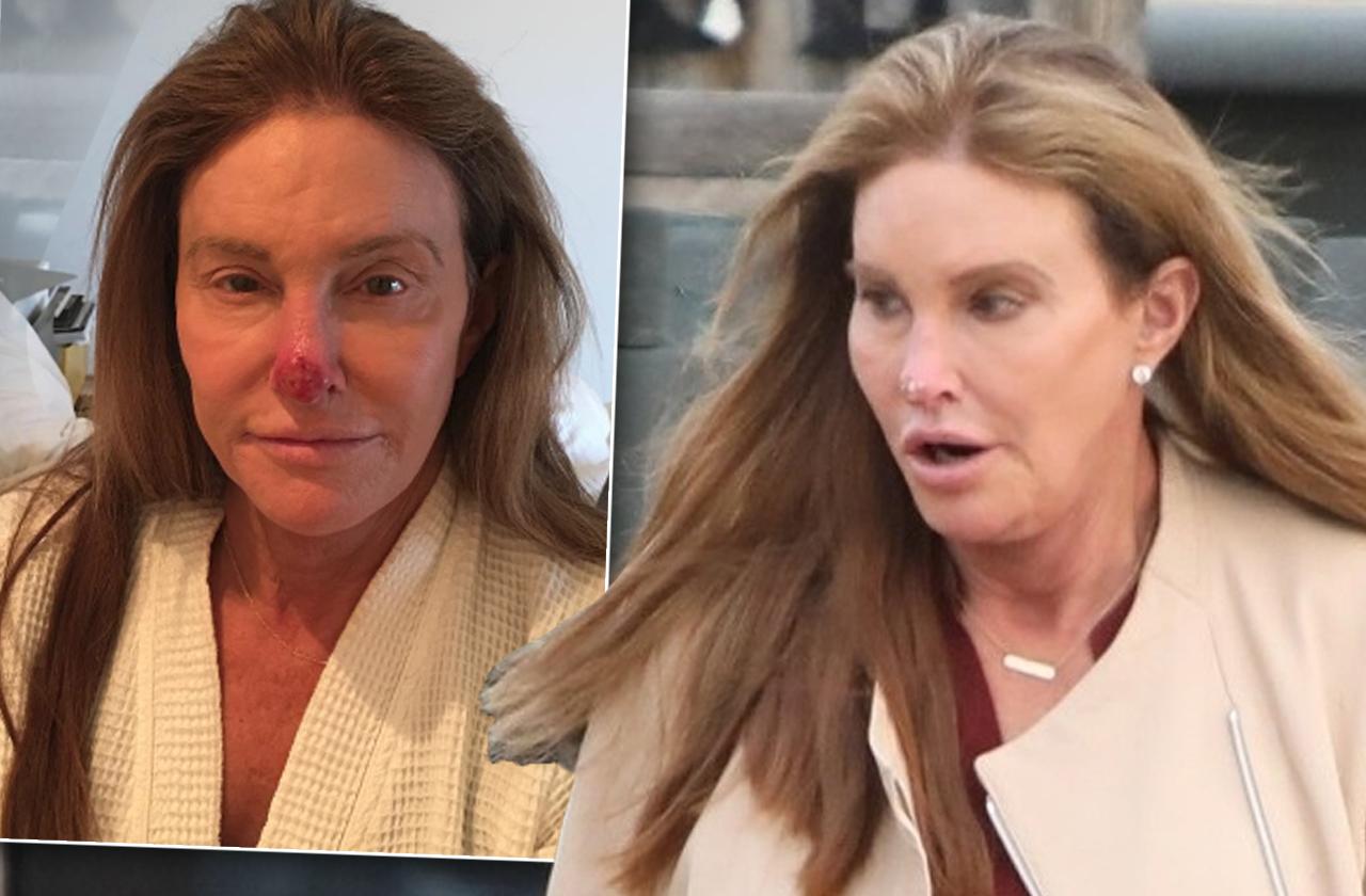 caitlyn jenner cancer skin sun damage nose