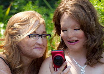 //angel faces burn victim