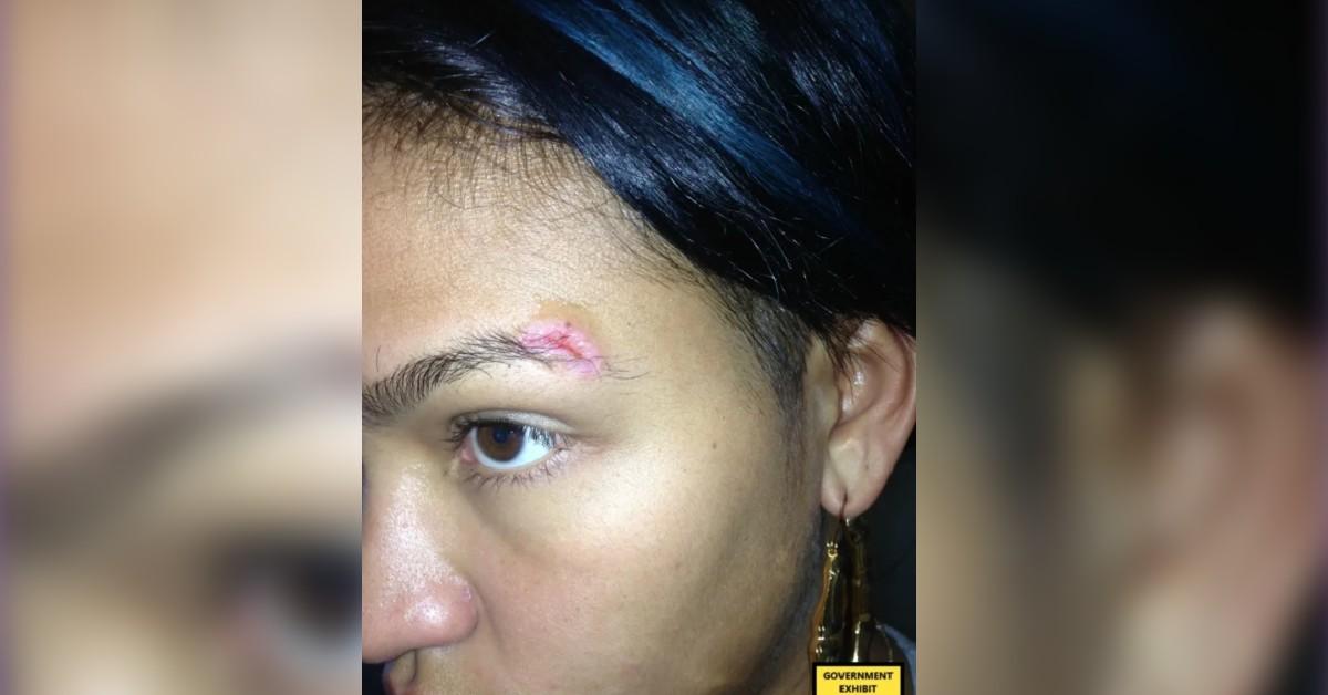 Cassie Ventura's injuries.