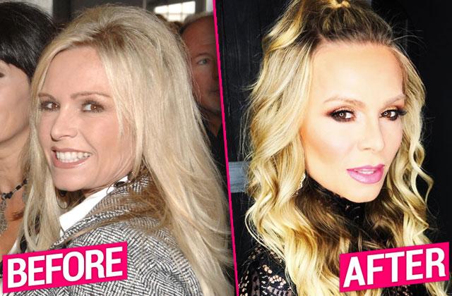 //Tamra Judge Plastic Surgery Fillers Botox Eyelid pp