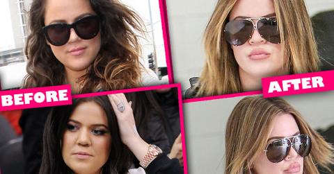 Khloe Kardashian Lip Injections