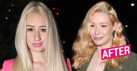 ggy Azalea Plastic Surgery Face Before After Photos